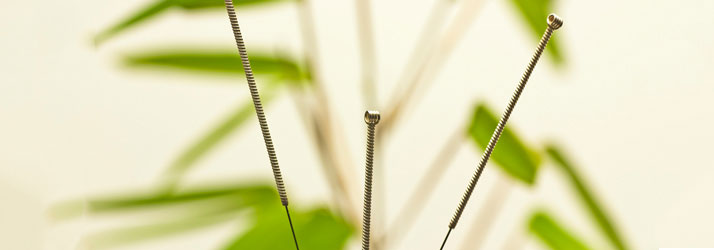 Acupuncture-in-SE-Calgary Acupuncture in SE Calgary